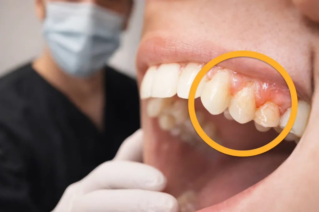 ENCIAS QUE SANGRAN PORTADA EVODENTAL