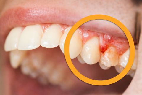 SANGRADO DE ENCIAS EVODENTAL
