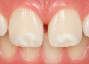 Las manchas blancas en los dientes: causas, tipos y soluciones